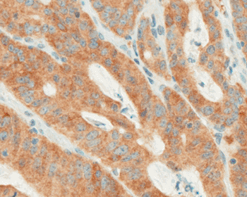 Imagen B: Un carcinoma colorrectal positivo con BRAF V600E (VE1) IHQ usando la detección OptiView DAB IHQ (Fotografía cortesía de Ventana).